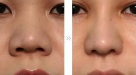 哪位醫(yī)生在全國(guó)范圍內(nèi)的脂肪填充領(lǐng)域技術(shù)比較好？