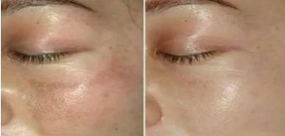 中國醫(yī)院雙眼皮修復(fù)技術(shù)，2023新晉熱門曝光！