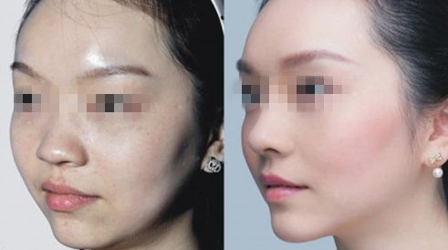 臺(tái)州哪家醫(yī)院治療乳頭矯正效果好？