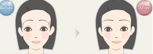 浙江哪家醫(yī)院眼袋祛除效果好？