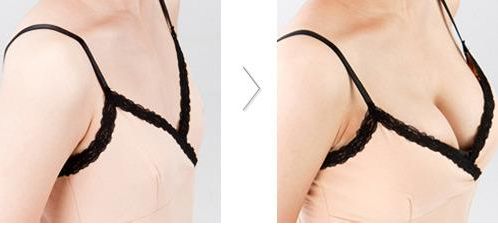 三明市第二醫(yī)院重磅推薦：陳國章醫(yī)生絕佳雙眼皮+內(nèi)眼角完美案例！