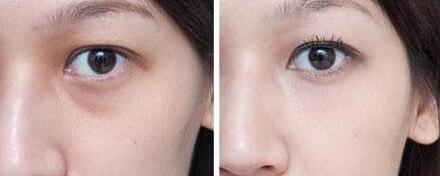 杭州藝星拉皮手術(shù)真的有效嗎？