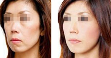 果酸祛痘間隔多久做一次？效果不明顯怎么辦？