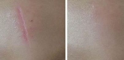 尋覓醫(yī)術出眾的武漢雙眼皮修復醫(yī)生，誰是不二之選？