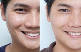 磨骨手術(shù)：價(jià)格差異與影響因素