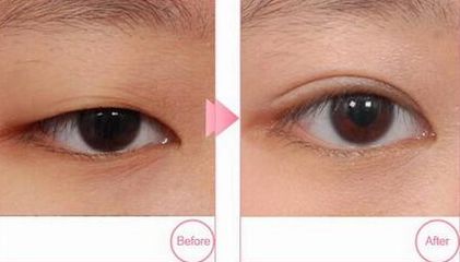 青島市立醫(yī)院雙眼皮割哪位醫(yī)生技術(shù)精湛？附案例和價格表參考