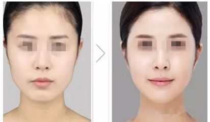 廣東哪家整形醫(yī)院醫(yī)師團(tuán)隊(duì)強(qiáng)大？筆者推薦廣東省人民醫(yī)院整形外科