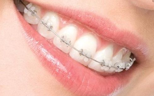 長(zhǎng)沙瑞瀾李增產(chǎn)雙眼皮效果揭曉，2023最新案例揭露