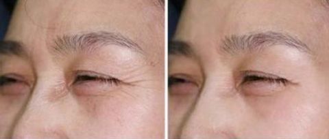 長沙菲瀾整形醫(yī)院醫(yī)生名冊(cè)揭曉｜雙眼皮整形案例分享 + 價(jià)格一覽