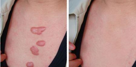 【重慶軍醫(yī)大學胡金香割雙眼皮效果如何？專家案例揭秘！】