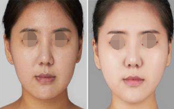 西安整形醫(yī)院的磨骨技術(shù)有哪些優(yōu)點？