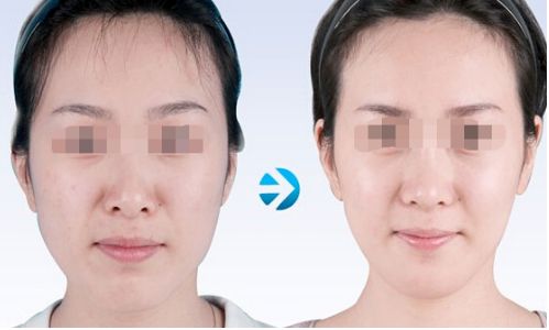 東莞締美蔣翔峰鼻整形口碑揭秘：技術(shù)水準(zhǔn)與案例賞析