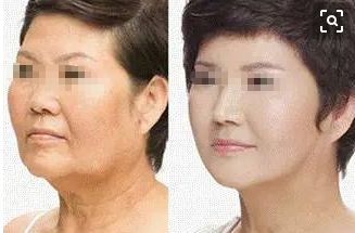 成都去痣名醫(yī)推薦，排行榜前五名有誰(shuí)？