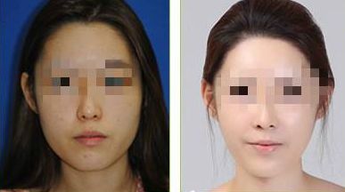 北京潤美玉之光脂肪填充測評(píng)：真實(shí)案例分享，效果與成活率分析