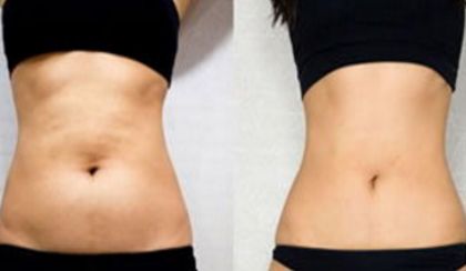 深圳有哪位醫(yī)生被推薦做拉皮手術(shù)？曹孟君、文豐值得考慮！