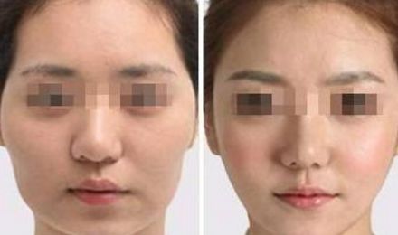 揭秘北京東方和諧脂肪填充真容，真實案例展示精湛技藝！