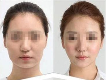 點(diǎn)痣祛疤指南：恢復(fù)期護(hù)理與注意事項(xiàng)