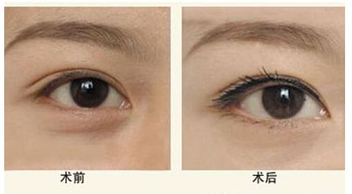 廣州墊下巴哪家醫(yī)院好？口碑技術(shù)分析及價格參考