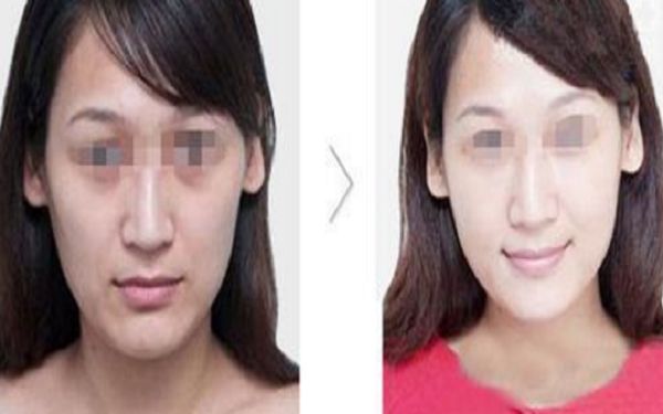 昆明鼻部整形醫(yī)院綜合評價排行榜