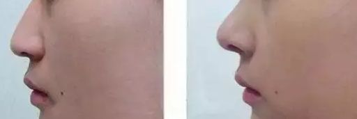 梁曉健隆鼻手術(shù)結(jié)果及費(fèi)用詳細(xì)解析