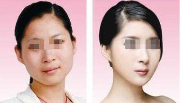 大連附屬二院美容科恢復效果實拍，價格揭秘