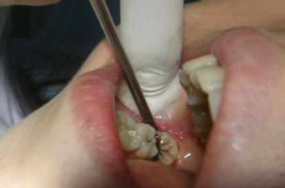 植發(fā)術(shù)后養(yǎng)護(hù)指南：術(shù)后第二天吃燒烤的影響