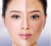 劉志剛醫(yī)生雙眼皮手術(shù)效果怎么樣？