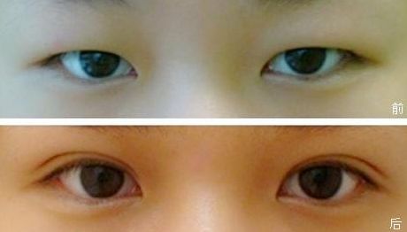 上海九院雙眼皮手術(shù)效果怎么樣？錢云良醫(yī)師的全新案例分享