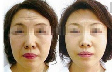 四川人民醫(yī)院王佳醫(yī)生提供下頜角整形案例，讓你輕松擁有小V臉