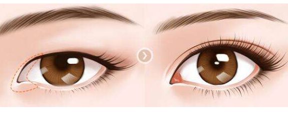 肖海濤的雙眼皮割成效如何？獨(dú)特技術(shù)吸引圈粉！