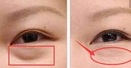 上海楊亞益雙眼皮修復(fù)技術(shù)解析，案例分享全文解讀