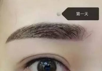 馮斌自體脂肪豐胸效果如何？案例分享給您