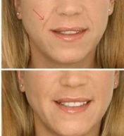 長(zhǎng)沙東宸醫(yī)療整容醫(yī)生推薦技術(shù)成果展現(xiàn)，費(fèi)用參考來(lái)啦！