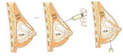深圳肖東興醫(yī)生雙眼皮手術(shù)出色，讓你煥然一新！80天前的成功案例重磅揭曉！