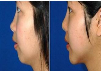 長春銘醫(yī)整形注射哪位醫(yī)師技術(shù)精湛？專家推薦與費(fèi)用一覽