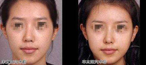 廣州雙眼皮整形市場：熱門口碑機構選擇這幾家準沒錯