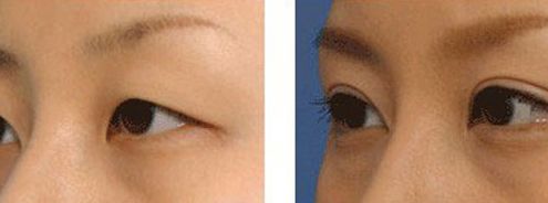 上海九院凸嘴手術(shù)費(fèi)用高昂？手術(shù)技術(shù)如何？推薦醫(yī)生參考