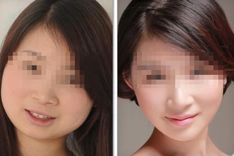 國內(nèi)備受矚目的小拉皮手術頂級專家一覽