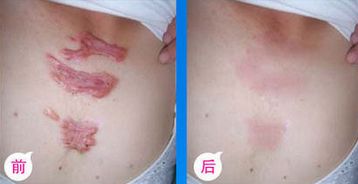 九院脂肪填充，醫(yī)生技術高超，詳細價格表揭曉