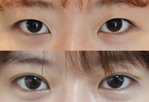 廣州曙光整形醫(yī)院的鼻部整形效果如何？收費(fèi)如何？真實(shí)案例分享！