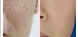 郭金冉面部填充成本公開(kāi)！醫(yī)生個(gè)人技術(shù)評(píng)價(jià)曝光！在線(xiàn)案例展示！