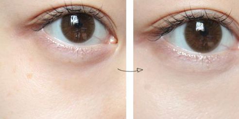 德陽王亞國(guó)雙眼皮修復(fù)90天體驗(yàn)細(xì)節(jié)圖分享