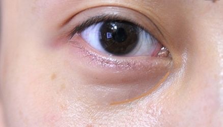 【重慶】銅雀臺雙眼皮醫(yī)生技術(shù)對比，伍森林、王杰醫(yī)、梁海彬誰更厲害？