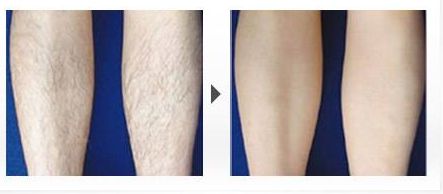 脂肪豐額頭手術(shù)的效果如何？了解專家的分享