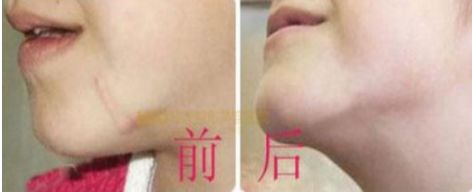 長沙最佳吸脂手術(shù)醫(yī)院排名，雅美、華韓華美、鵬愛等值得借鑒的評價