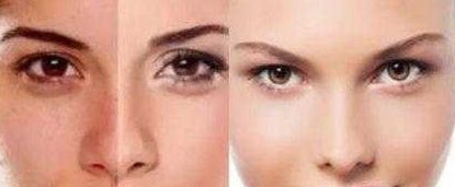 溫州陳熙醫(yī)生精湛技藝解決眼袋問(wèn)題