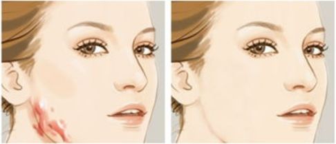 成都光子嫩膚的醫(yī)院選擇有哪些？推薦值得信賴的三甲公立機(jī)構(gòu)！