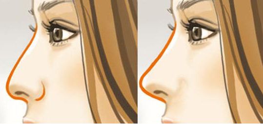 上海哪個(gè)醫(yī)院雙眼皮手術(shù)效果最自然？名醫(yī)名單和成功案例供參考