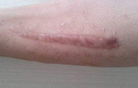 北京藝星白書白師傅，2023獨家案例揭秘：雙眼皮手術讓你閃耀美麗！