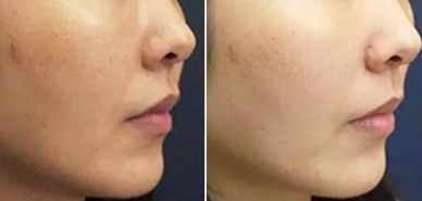 八大處王佳琦醫(yī)生獨(dú)家技術(shù)！驚艷去眼袋，50天展示成果震撼！